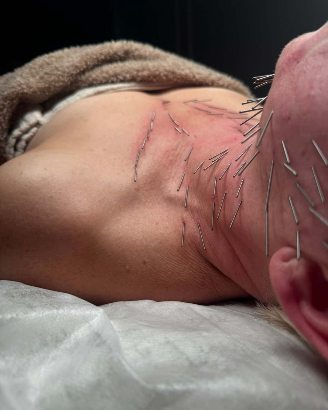 Stymulacja kolagenu igłami i prądem elektrycznym - jak działa zabieg