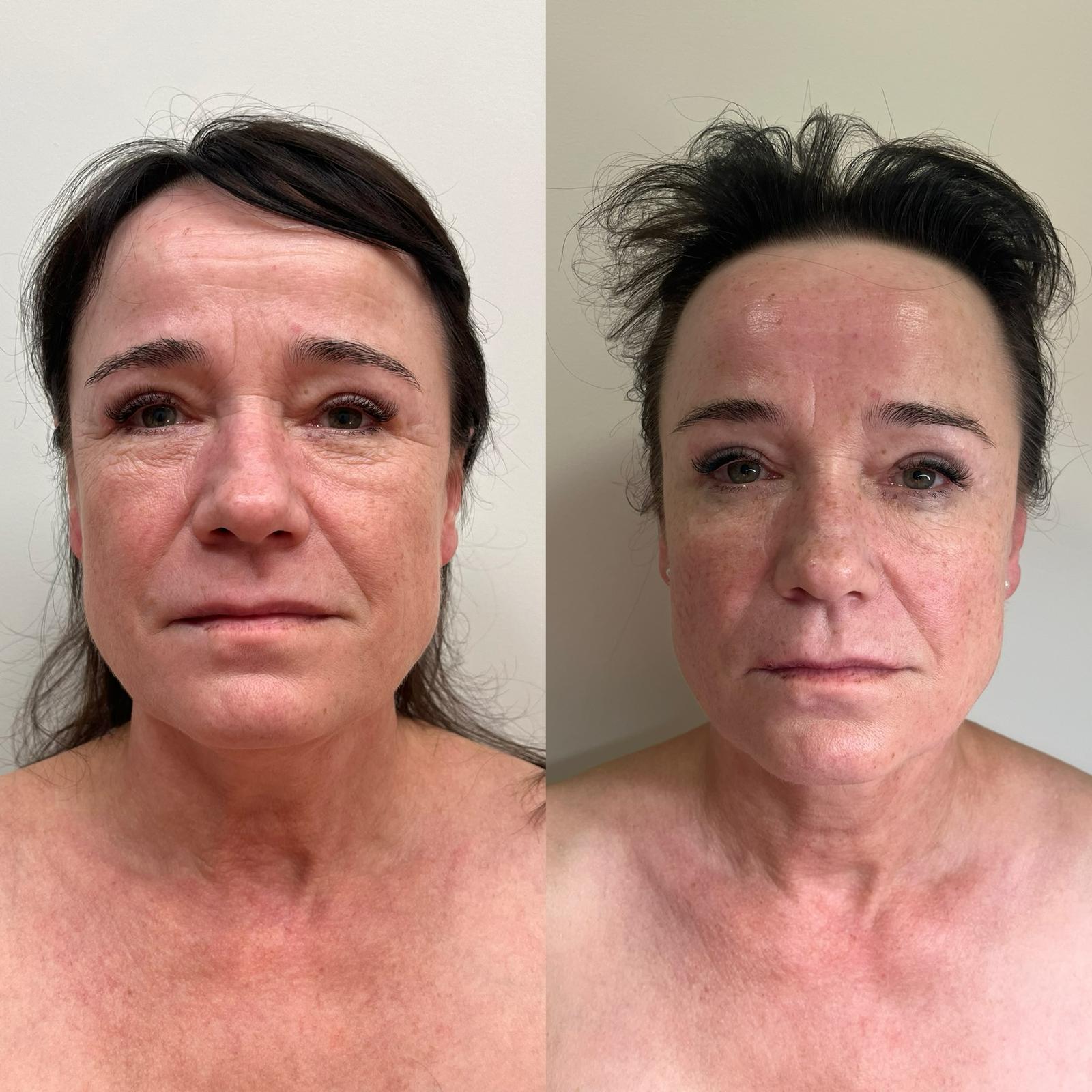 Efekty zabiegu PRP przed i po